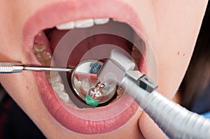 Macro shot of dental professional brushing with dentist mirror