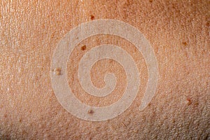 Macro shot of the human skin with nevi, moles. photo