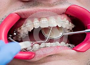 Macro shot of teeth with braces and dental retractor