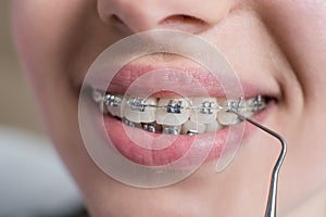 Macro shot of teeth with braces. Female patient with metal brackets at the dental office. Orthodontic Treatment.