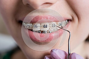 Macro shot of white teeth with braces. Female patient with metal brackets at the dental office. Orthodontic Treatment.