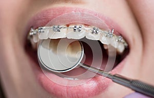 Macro shot of white teeth with braces. Female patient with metal brackets at the dental office. Orthodontic Treatment. photo