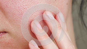 Macro skin with enlarged pores. The girl touches the irritated red skin with her fingers. Allergic reaction, peeling