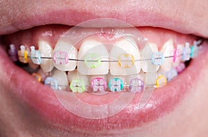 Macro snapshot of white teeth and ceramic braces with colorful rubber bands on them, beautiful smile