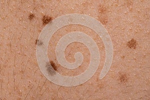 A macro view of benign nevi on Caucasian skin.