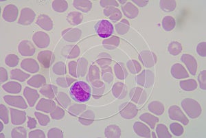 Macrocytosis.