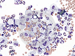 Macrophages in pleural fluid. photo
