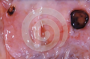 Peptic ulcer photo