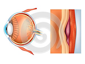 Macular degeneration, also known as age-related macular degeneration. AMD or ARMD. Damage to the macula photo