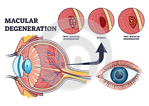 Macular degeneration as eye illness and eyesight problem outline diagram