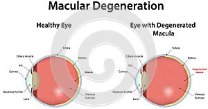 Macular Degeneration