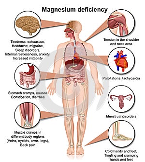 Magnesium deficiency 3d medical vector illustration isolated on white background infographic