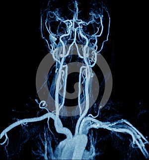 Magnetic Resonance Angiogram of the brain vasculature arteries photo