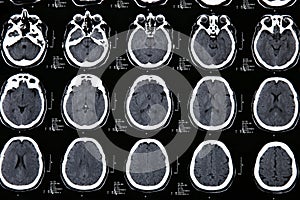 Magnetic resonance of a brain photo