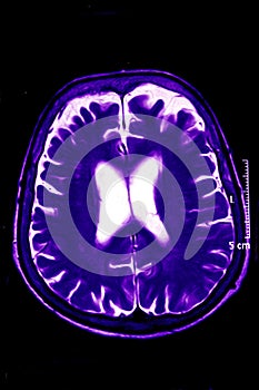 Magnetic Resonance of Brain, blue