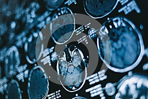 Magnetic resonance brain image scan
