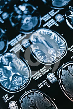 Magnetic resonance brain image scan