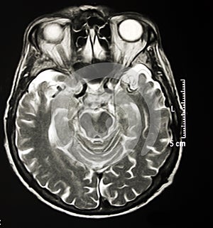 Magnetic Resonance Of Brain, MR