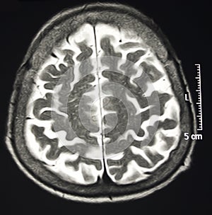 Magnetic Resonance Of Brain, MR photo