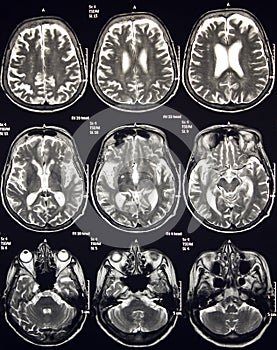 Magnetic Resonance Of Brain, MR