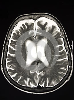 Magnetic Resonance Of Brain, MR