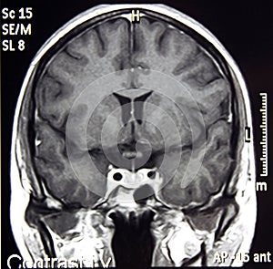 Magnetic Resonance Of Brain, MR photo