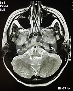 Magnetic Resonance Of Brain, MR photo