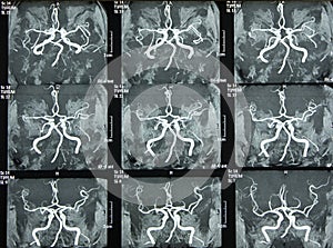 Magnetic Resonance Of Brain Vessels, MR