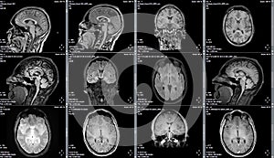 Magnetic resonance image of a brain