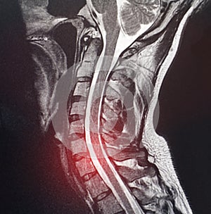 Magnetic resonance image of the cervical spine of a patient who has pain and numbness in the neck. The concept of diagnosis and photo