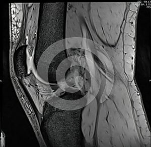 Magnetic resonance image of the knee joint  MRI kneein sagittal plan
