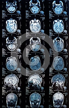 Magnetic resonance image MRI of the brain