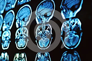 Magnetic resonance image scan of the brain. MRI film of a human skull and brain. Neurology background.