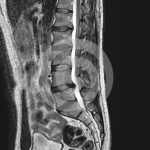 magnetic resonance image - vertebrae of spine with one herniated disc that presses on the spinal cord