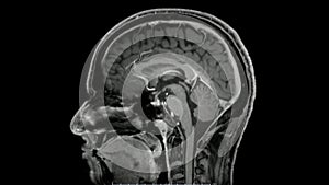 Magnetic resonance  images of the brain MRI brain sagittal post contrast sequence photo