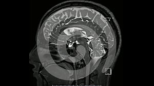 Magnetic resonance  images of the brain MRI brain sagittal T2 weighted sequence