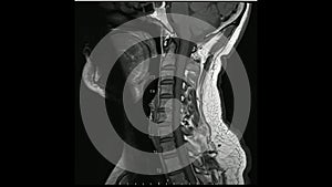 Magnetic Resonance images of Cervical spine sagittal T1-weighted images in Cine mode MRI Cervical spine