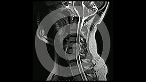 Magnetic Resonance images of Cervical spine sagittal T2-weighted images in Cine mode MRI Cervical spine