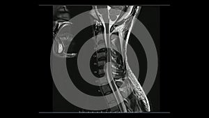 Magnetic Resonance images of Cervical spine sagittal T2-weighted images  MRI Cervical spine