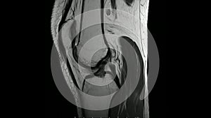 Magnetic Resonance images of  The Knee joint Sagittal T1- weighted Images