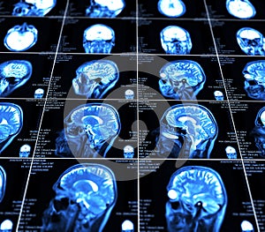 Magnetic resonance imaging of the brain