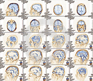 Magnetic resonance imaging of the brain