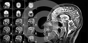 Magnetic resonance imaging of the brain