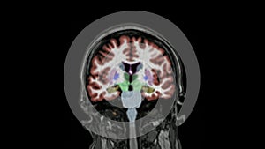 MRI brain. Alzheimer disease.