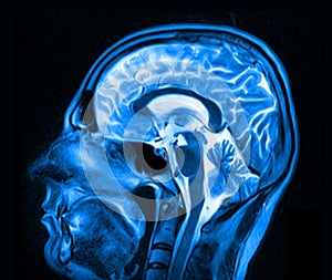 Magnetic resonance imaging of the brain photo