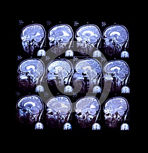 Magnetic Resonance Imaging of Brain - Skull Medical Analysis