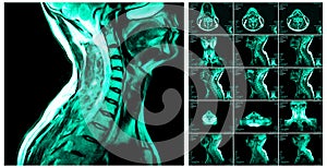 Magnetic resonance imaging of the cervical spine.