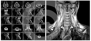 Magnetic resonance imaging of the cervical spine.