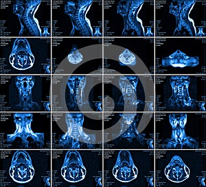 Magnetic resonance imaging of the cervical spine.