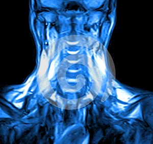 Magnetic resonance imaging of the cervical spine.